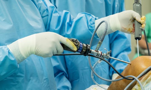 Arthroscopy